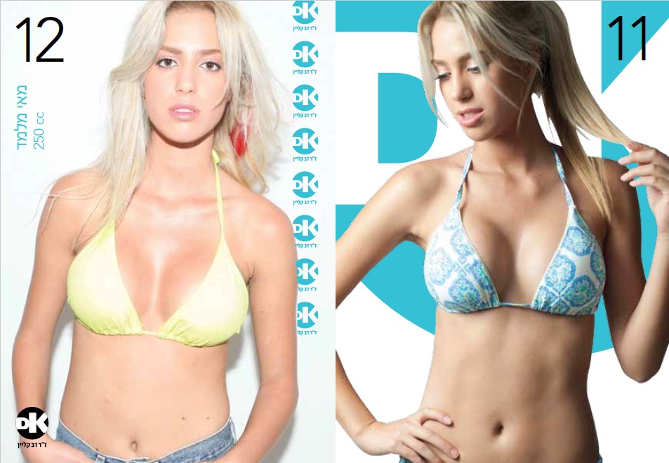 מאי מלמד - עברה ניתוח חזה אצל ד"ר דב קליין